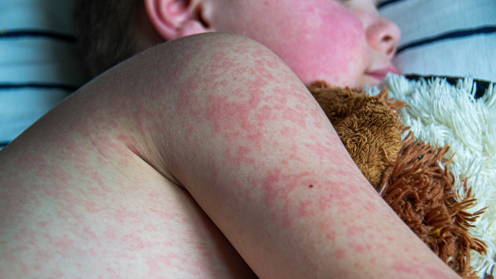 Infant with measles marks on arm and back